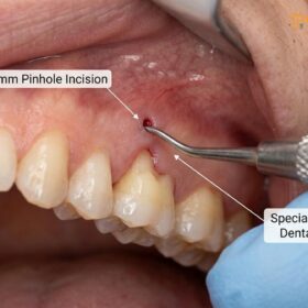 Pinhole Surgical Technique: Clinical Guide & Procedure | HCMC Dental