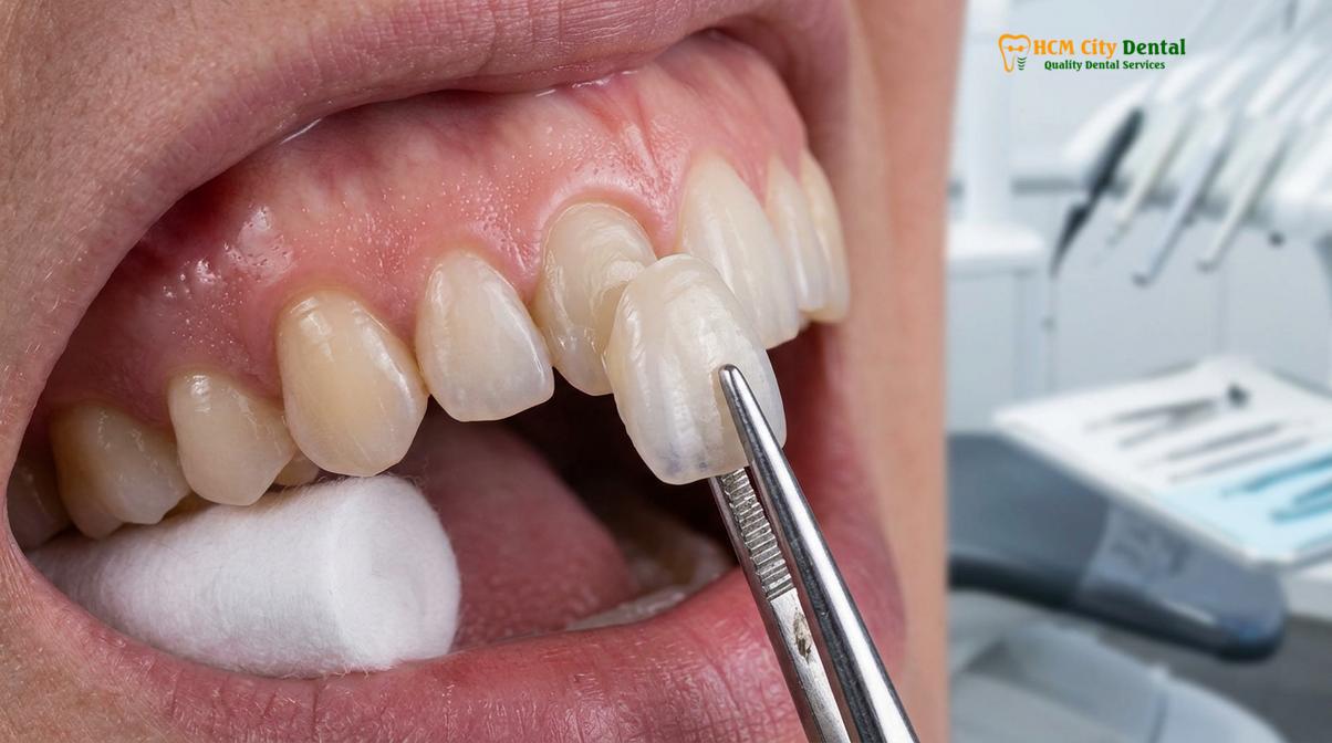 Visual description of veneers for crooked teeth