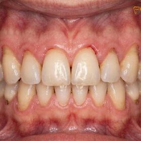Porcelain Veneers: Clinical Guide to Long Dental Aesthetics | HCMC Dental