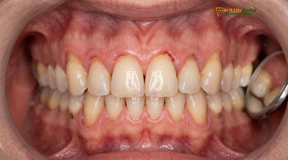 Clinical illustration of long dental