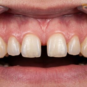 Veneers for Gaps: Clinical Guide to Closing Diastemas