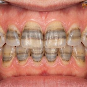 Veneers for Stained Teeth: Clinical Solutions for Deep Discoloration