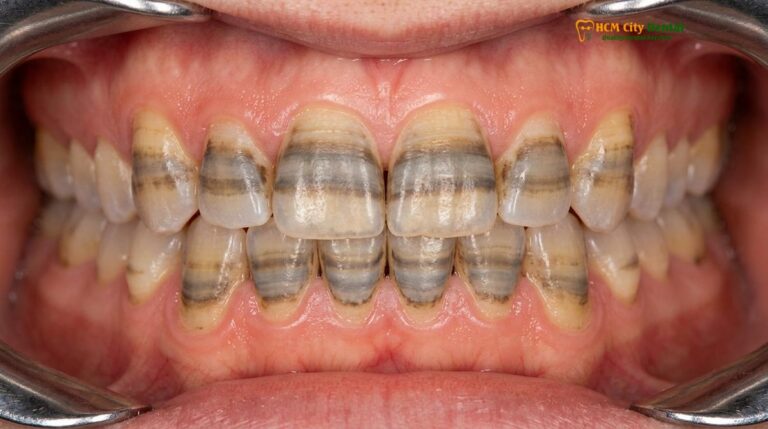Veneers for Stained Teeth: Clinical Solutions for Deep Discoloration