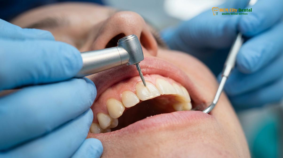 Clinical photography related to porcelain veneers procedure