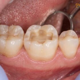 Porcelain vs Composite Inlay: Clinical Comparison & Costs