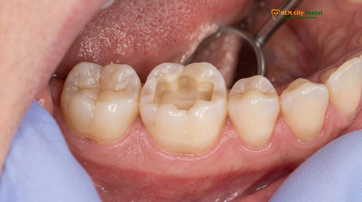 Clinical illustration of porcelain vs composite inlay