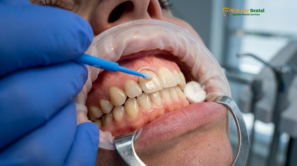 Visual description of prepare for dental crowns travel