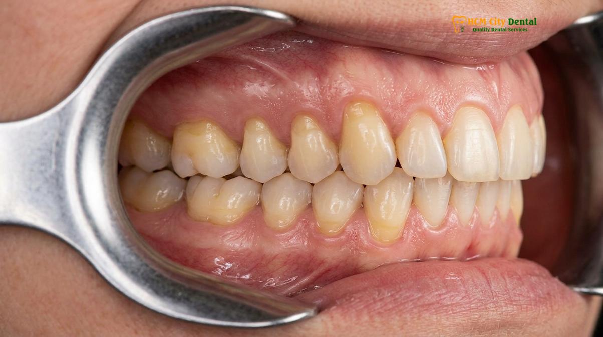 Visual illustration of receding gums treatment