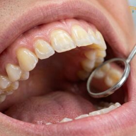 GERD Ruined My Teeth: Clinical Reconstruction & Full Mouth Rehabilitation