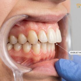 Can Braces Fix Overjet? Clinical Guide & Timelines | HCMC Dental