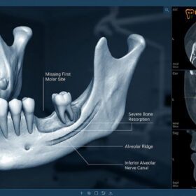 Replacing Extracted Teeth: Implants, Bridges & Partials | HCMC Dental