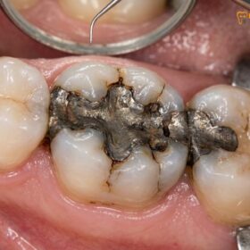 Replacing Old Silver Fillings Composite Vietnam | HCMC Dental