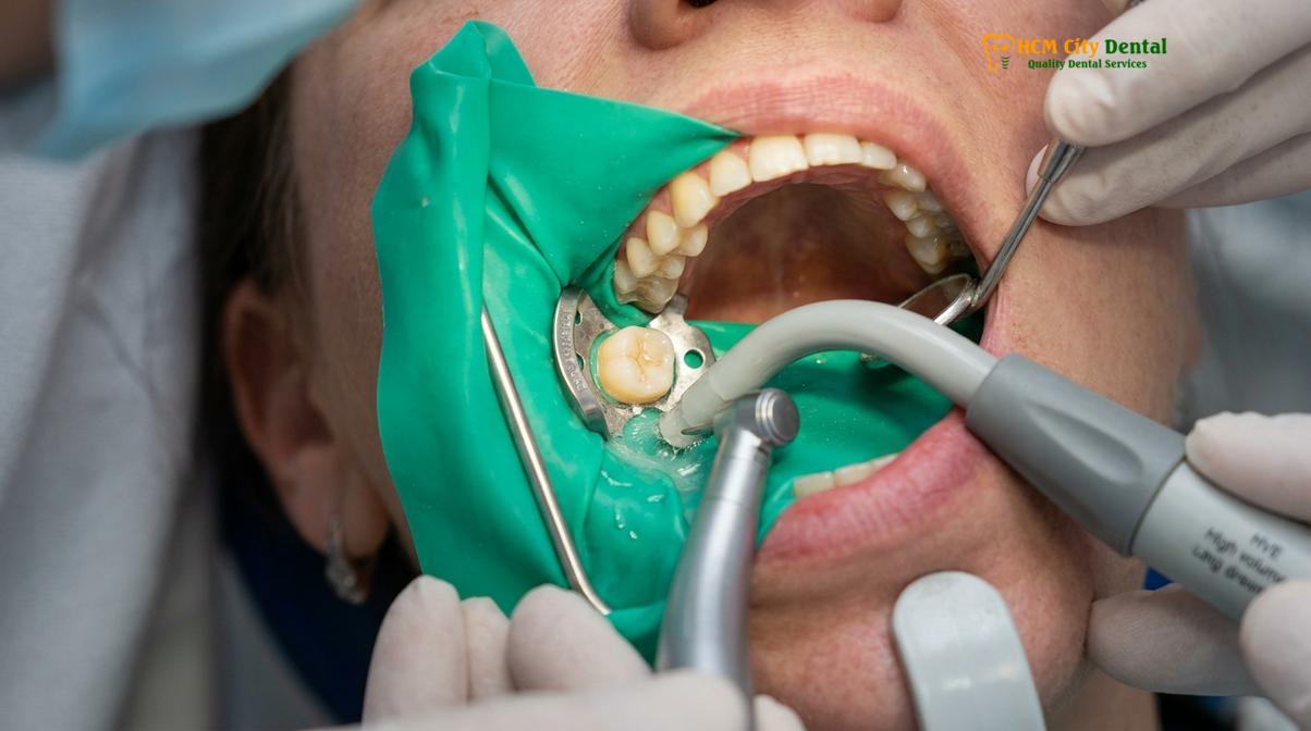 Visual description of Replacing Old Silver Fillings Composite Vietnam