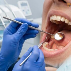 Dental Bridge vs Implant for Multiple Teeth: Clinical Comparison