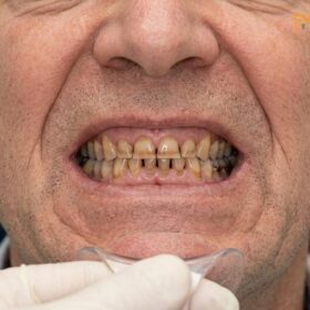 Vertical Dimension of Occlusion: Clinical Restoration Guide