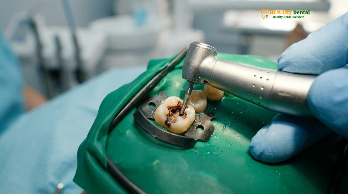 Visual illustration of Irreversible Pulpitis Treatment