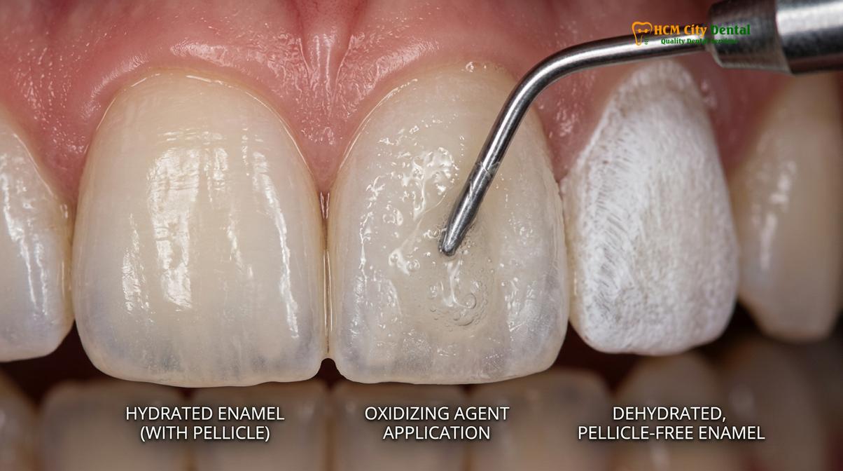 Clinical photography related to sensitive teeth after whitening remedies