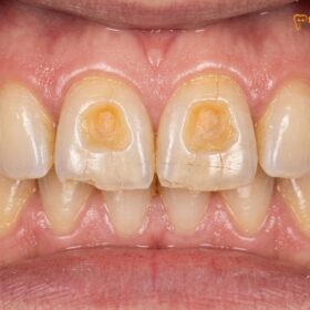 Severe Bruxism Damage: Clinical Stages & Treatment | HCMC Dental