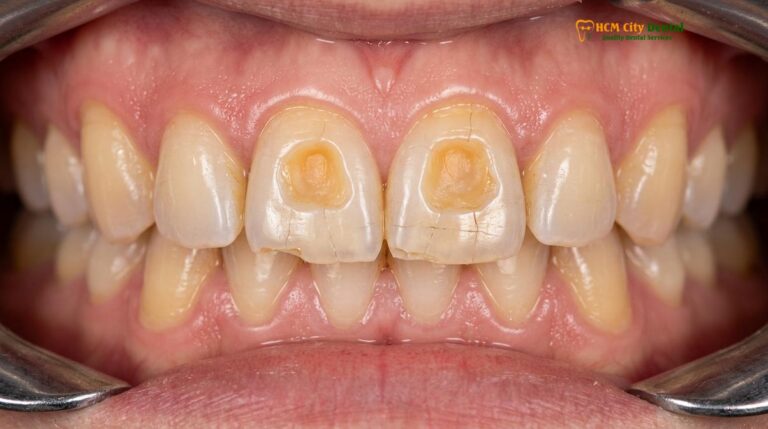 Severe Bruxism Damage: Clinical Stages & Treatment | HCMC Dental