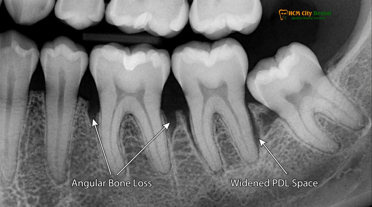 Visual description of Severe Bruxism Damage