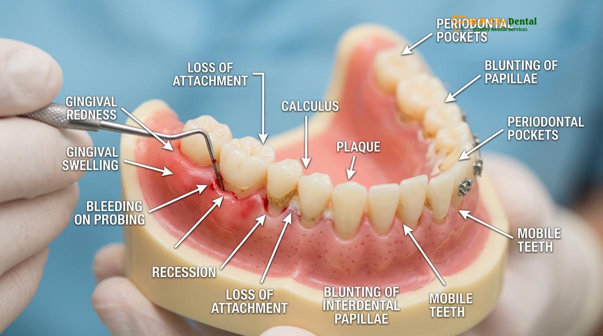 Clinical photography related to signs of gum disease