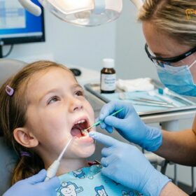 Silver Diamine Fluoride for Kids: Clinical Guide to Drill-Free Cavity Care