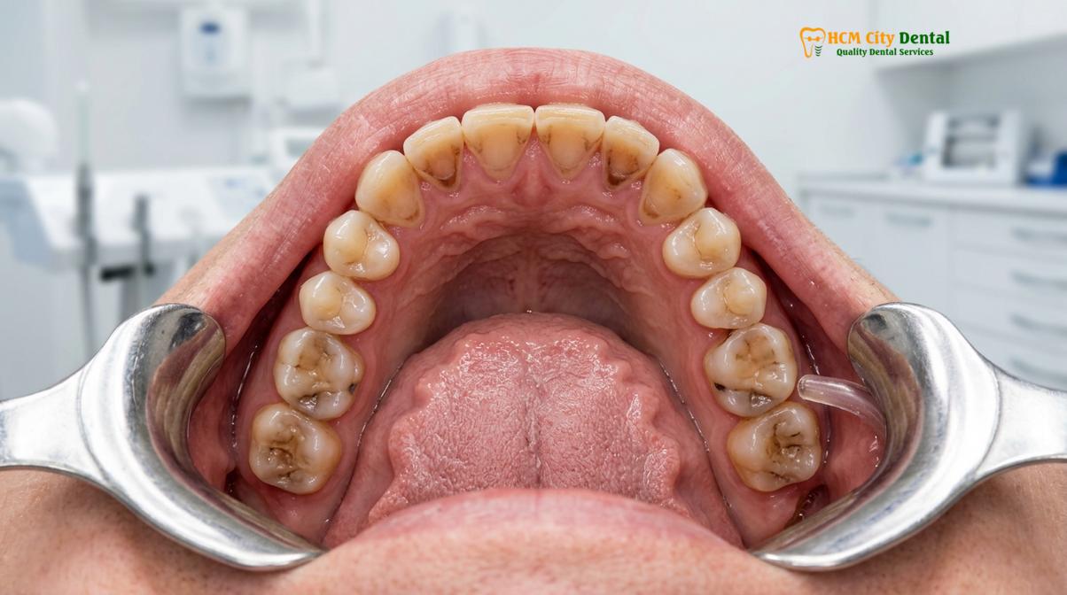 Visual illustration of Sleep Apnea and Teeth Grinding