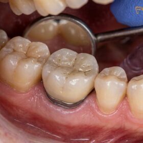 Sleep Apnea Dental Implants: Protecting Restorations & Airways