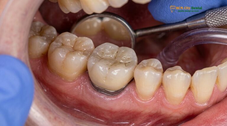 Sleep Apnea Dental Implants: Protecting Restorations & Airways