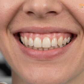Smile Design Gum Line: Clinical Workflows & Aesthetic Contouring