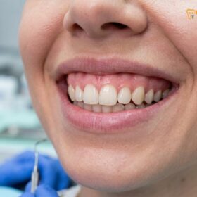 Lip Repositioning Surgery Saigon: Clinical Guide to Gummy Smile Correction