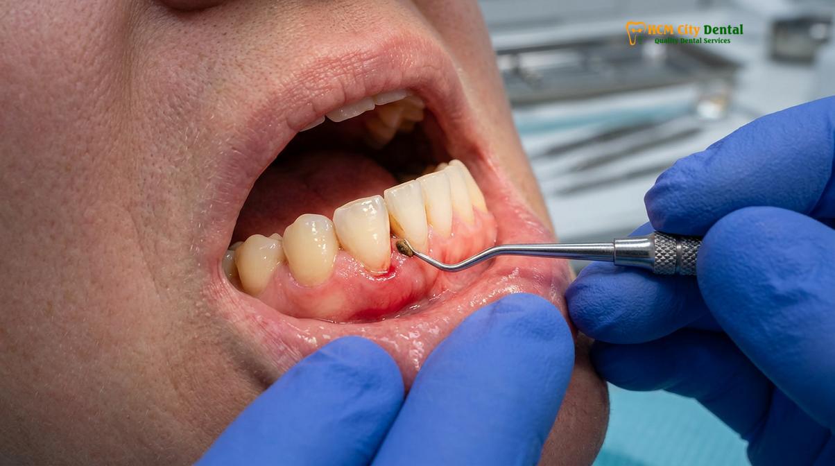 Visual description of swollen gums around tooth