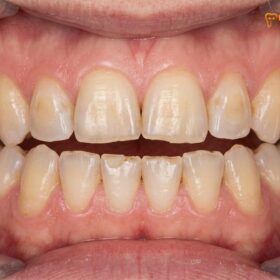 Bruxism and Veneers: Clinical Protocols for Teeth Grinders