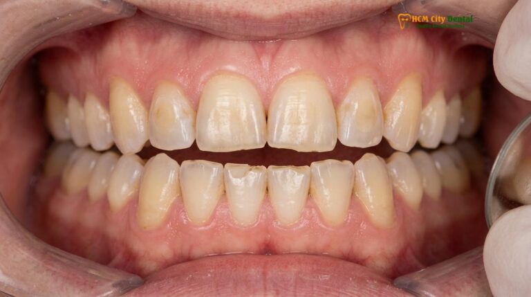 Bruxism and Veneers: Clinical Protocols for Teeth Grinders