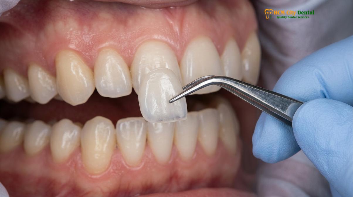 Visual description of bruxism and veneers