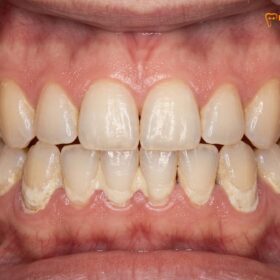 Teeth Polishing After Scaling: Clinical Protocols & Benefits