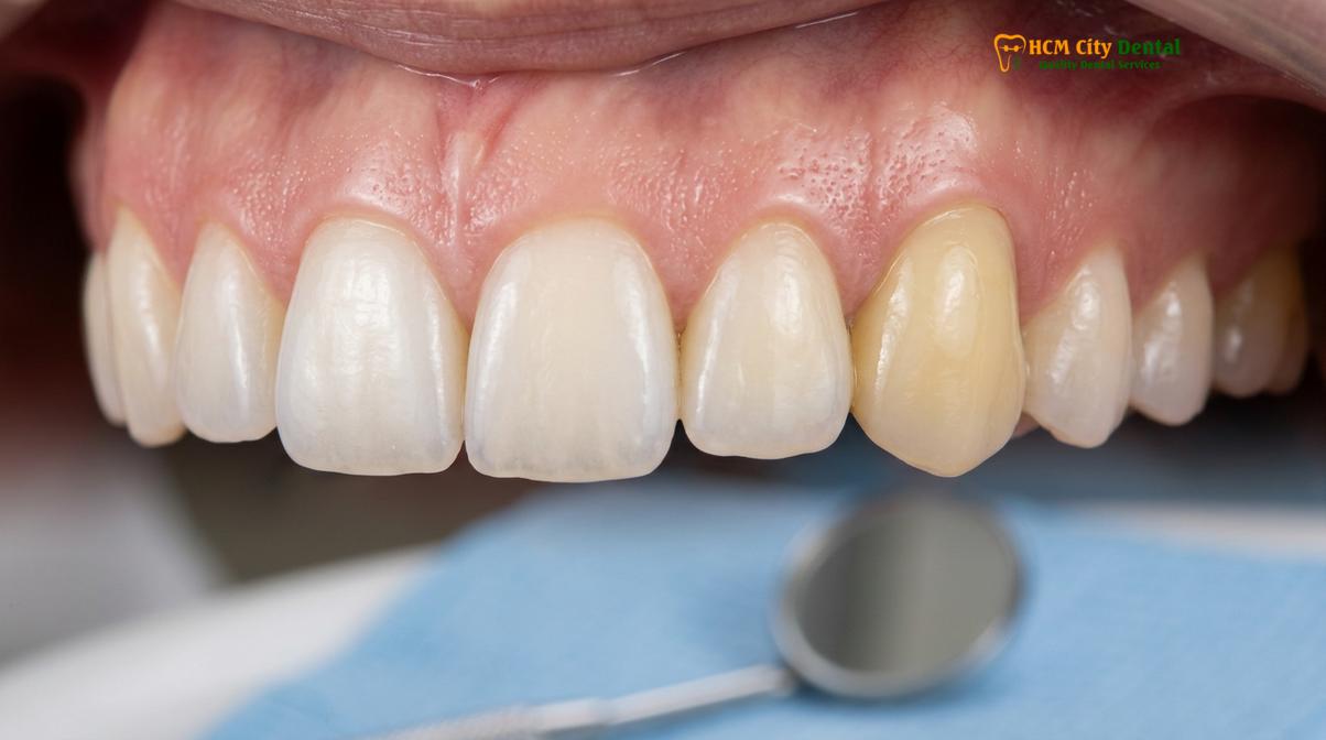 Visual description of teeth whitening before veneers crowns