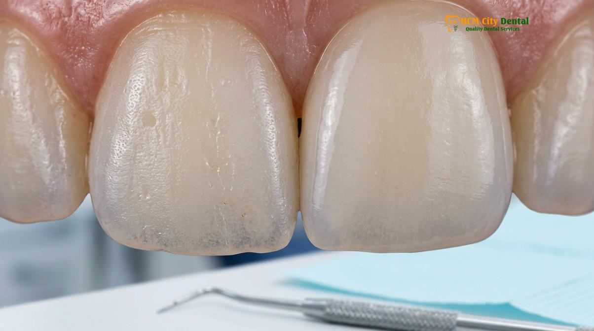 Clinical illustration of teeth whitening before veneers