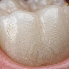 Is Teeth Whitening Safe for Enamel? A Clinical Dental Guide