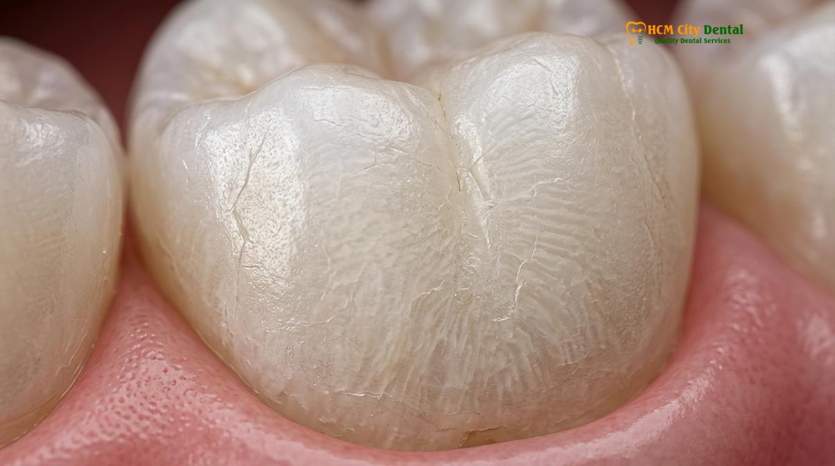 Is Teeth Whitening Safe for Enamel? A Clinical Dental Guide