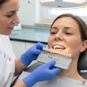 Teeth Whitening Strips vs Professional: A Clinical Comparison