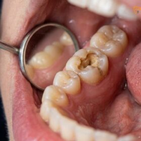 Temporary Tooth Repair DIY: Safe Clinical Guide | HCMC Dental