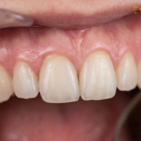 Temporary Veneers Care: Clinical Guidelines & Post-Prep Management
