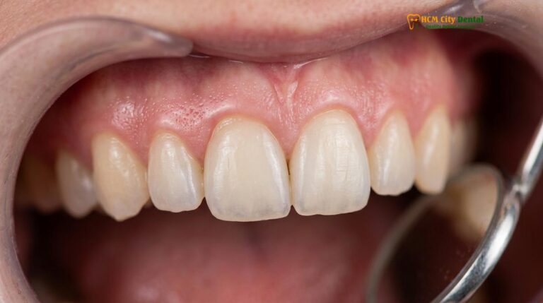 Temporary Veneers Care: Clinical Guidelines & Post-Prep Management