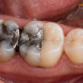 Tooth Colored Filling Materials GIC Composite Ceramic | HCMC Dental