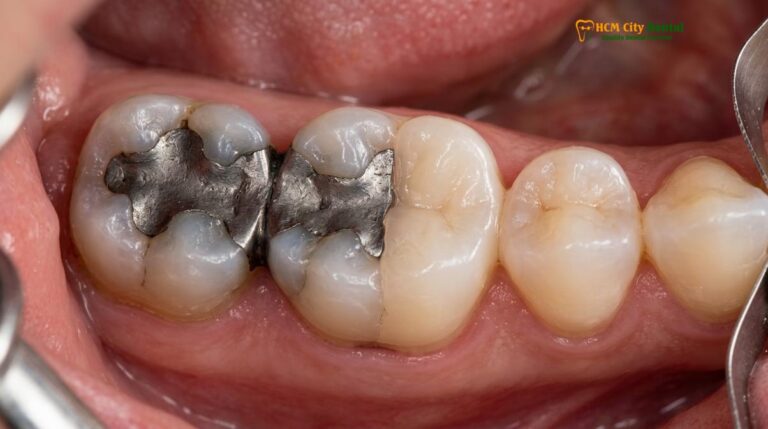 Tooth Colored Filling Materials GIC Composite Ceramic | HCMC Dental