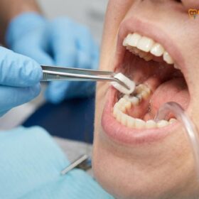 Tooth Pulp Vitality Test: Clinical Guide & Results | HCMC Dental