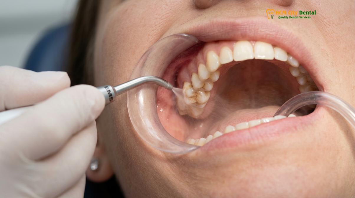 Clinical photography related to ultrasonic scaling vs airflow polishing