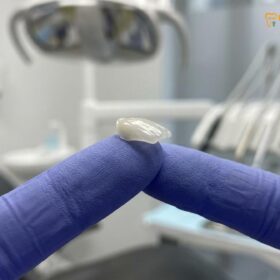 Ultra Thin Veneers: Clinical Guide to No-Prep Smile Design