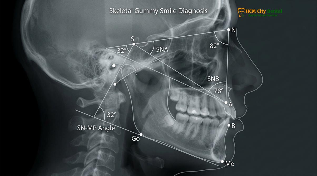 Clinical photography related to Vertical Maxillary Excess
